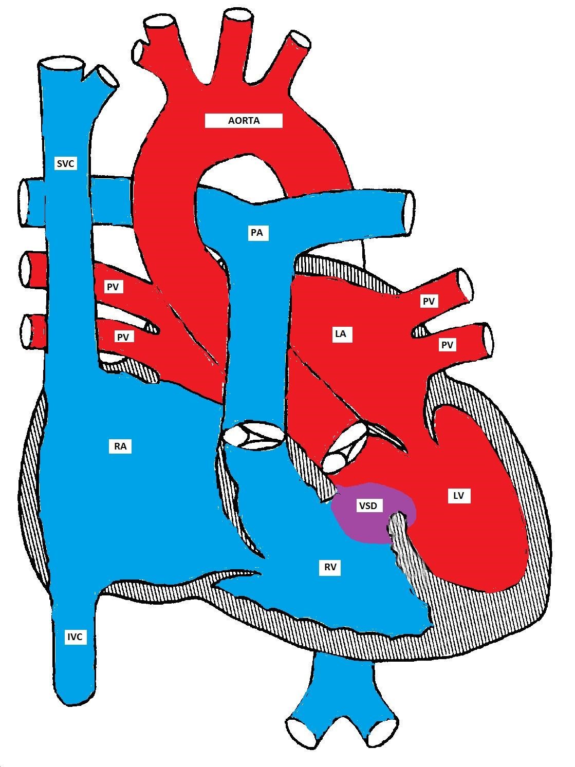 Figure showing a ventricular septal defect